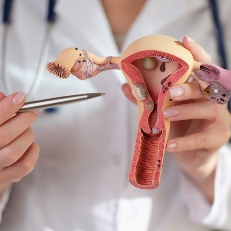 Síndrome de Ovarios Poliquísticos: Definición y Causas