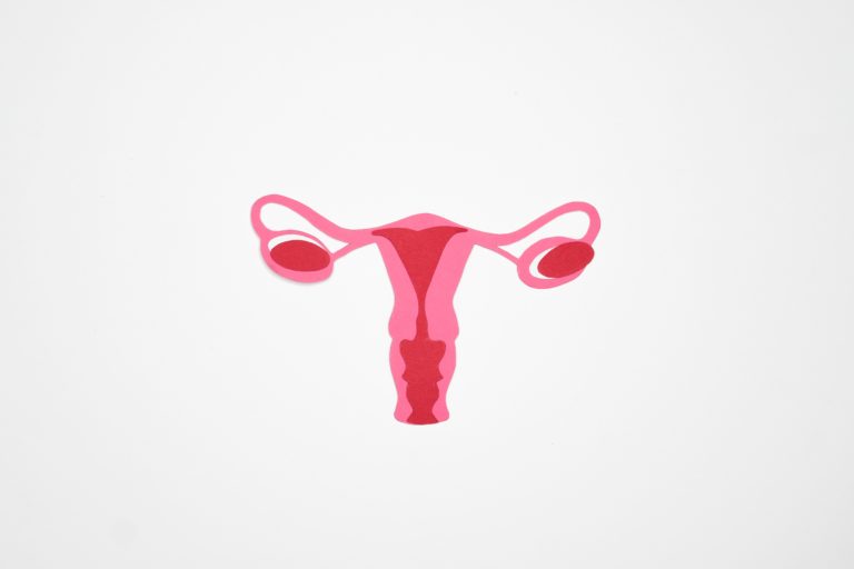 Tratamiento del Síndrome de Ovarios Poliquísticos